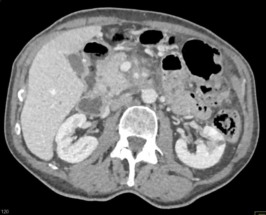 Pancreatic Cancer with Superior Mesenteric Artery (SMA) Encasement - CTisus CT Scan