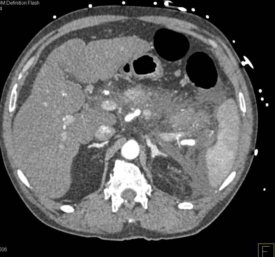 Acute Pancreatitis with Pancreatic Necrosis - CTisus CT Scan