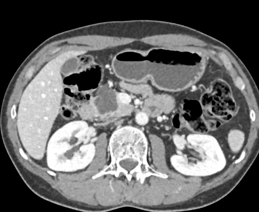 Intraductal Papillary Mucinous Neoplasm (IPMN) in the Head of the Pancreas - CTisus CT Scan