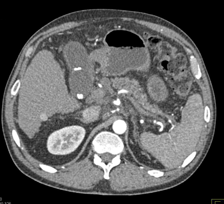 Pancreatic Cancer with Local Spread - CTisus CT Scan