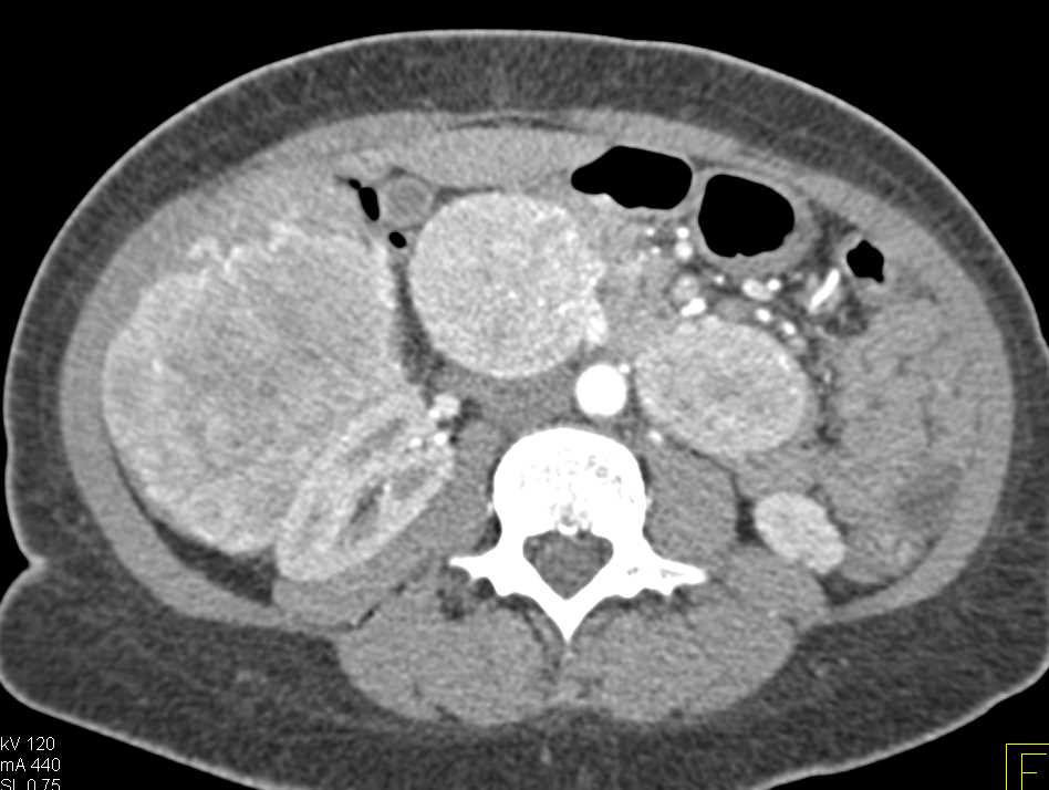 Metastatic Pancreatic Neuroendocrine Tumor - CTisus CT Scan