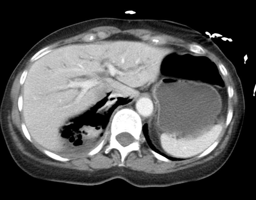 Post Endoscopic Retrograde Cholangiopancreatography (ERCP) Perforation with Retroperitoneal Abscess - CTisus CT Scan