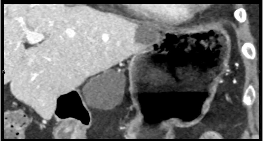 Lymphoepithial Cyst Body of the Pancreas - CTisus CT Scan