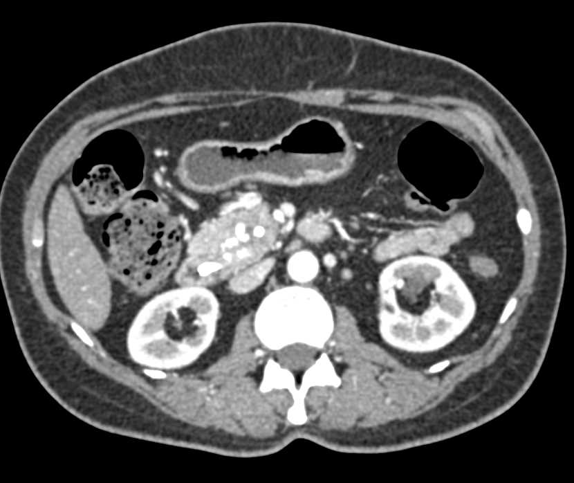 Pancreatic Cancer Arising in Chronic Pancreatitis - CTisus CT Scan