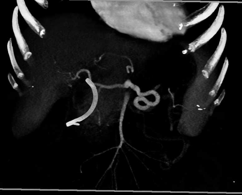 Pancreatic Adenocarcinoma with PV/SMV Involvement - CTisus CT Scan