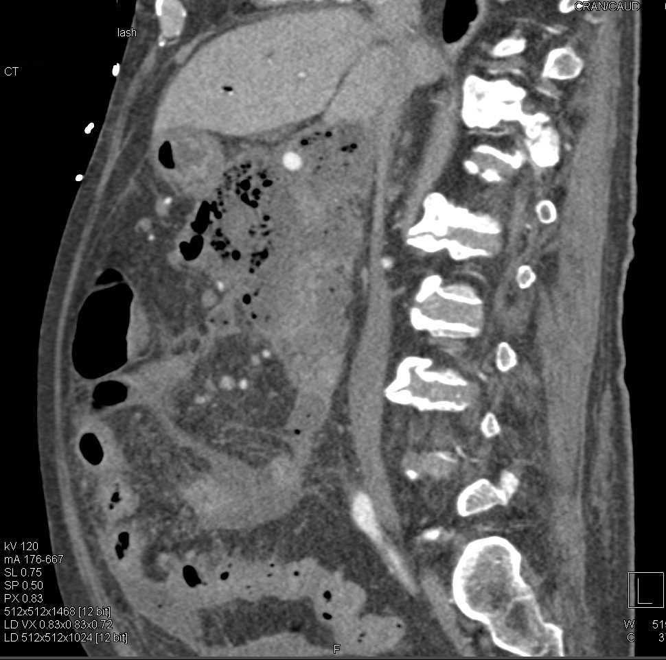 Infected Pancreatic Pseudocyst - CTisus CT Scan