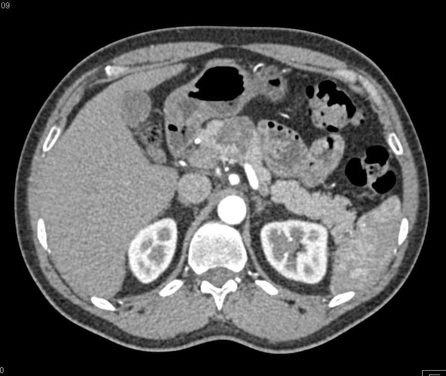 Serous Cystadenoma of Pancreas - CTisus CT Scan