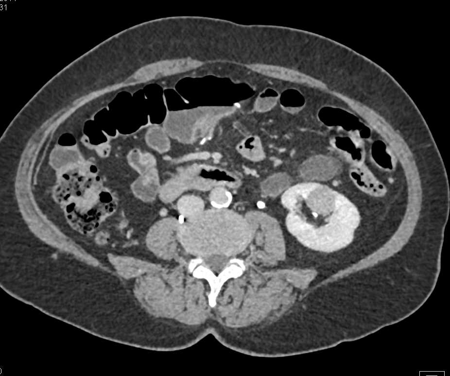Metastatic Renal Cell Carcinoma to the Pancreas - CTisus CT Scan