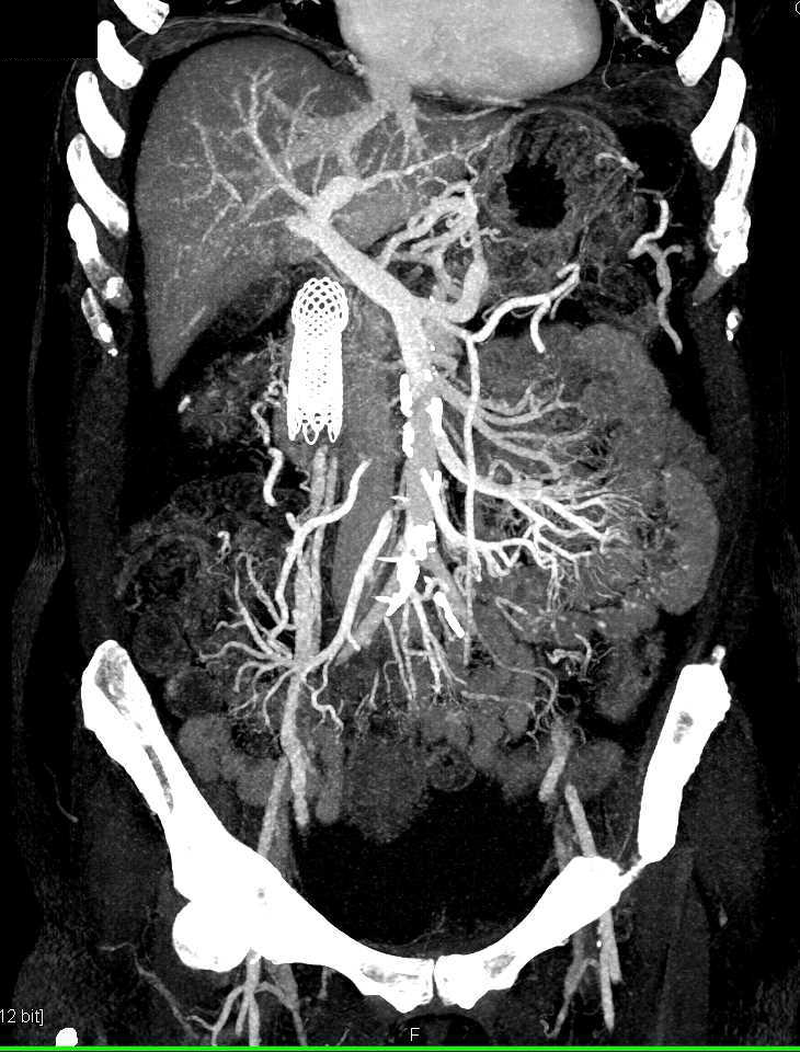 Pancreatic Cancer with Carcinomatosis - CTisus CT Scan