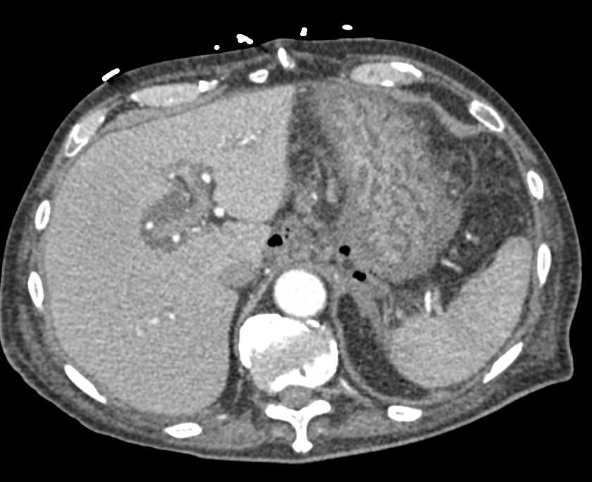 Necrotizing Pancreatitis - CTisus CT Scan