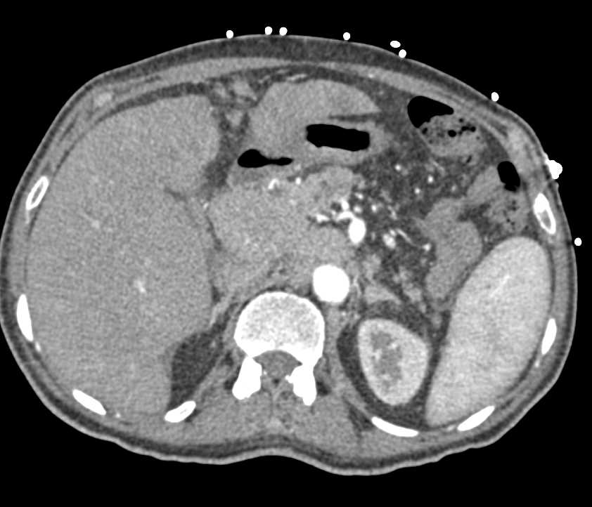 Pancreatic Cancer - CTisus CT Scan