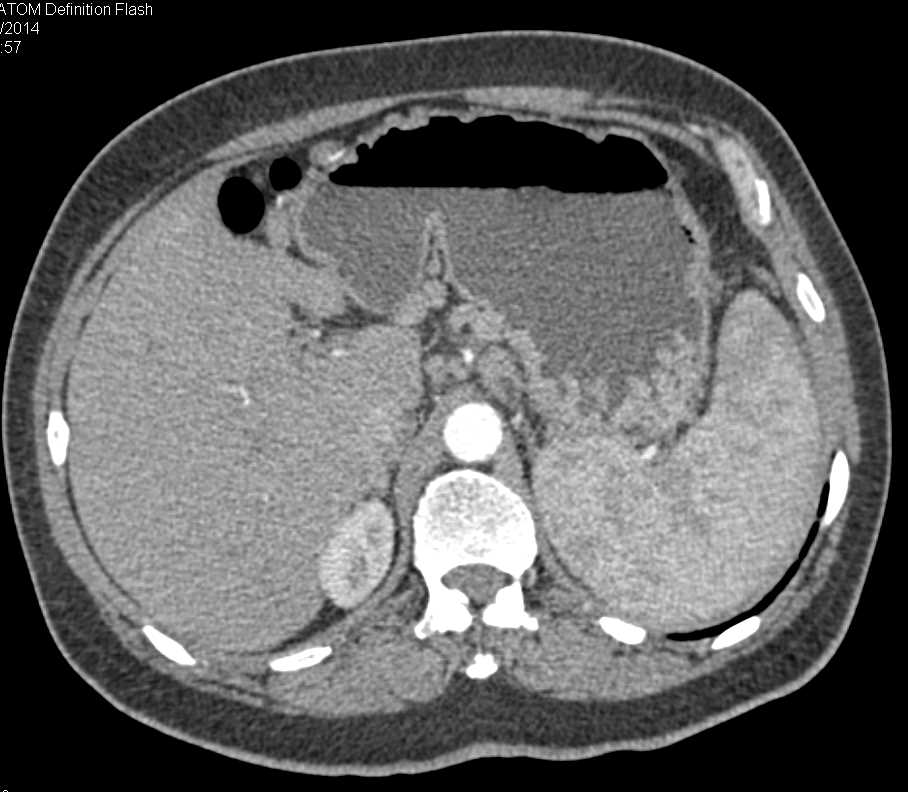 Carcinoma of the Tail of the Pancreas with Large Collaterals - CTisus CT Scan