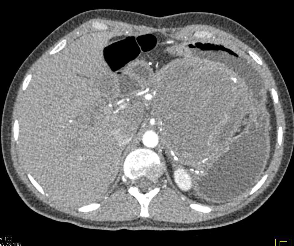 Solid and Papillary Epithelial Neoplasm (SPEN) Tumor Tail of the Pancreas - CTisus CT Scan