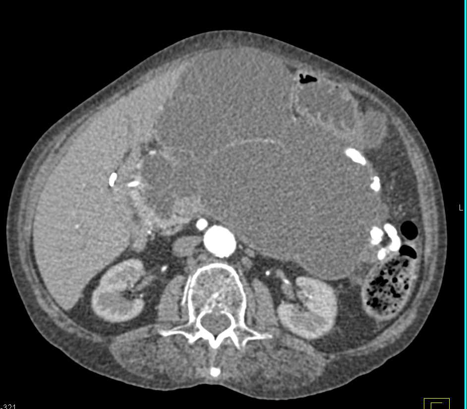 Serous Cystadenoma of the Pancreas - CTisus CT Scan
