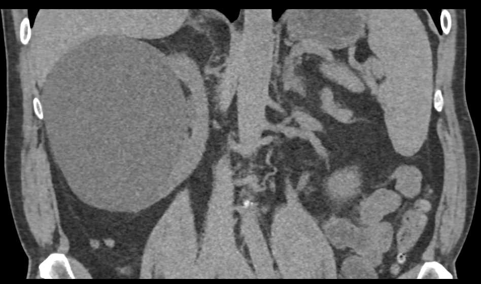 Bosniak 2F Renal Cysts - CTisus CT Scan