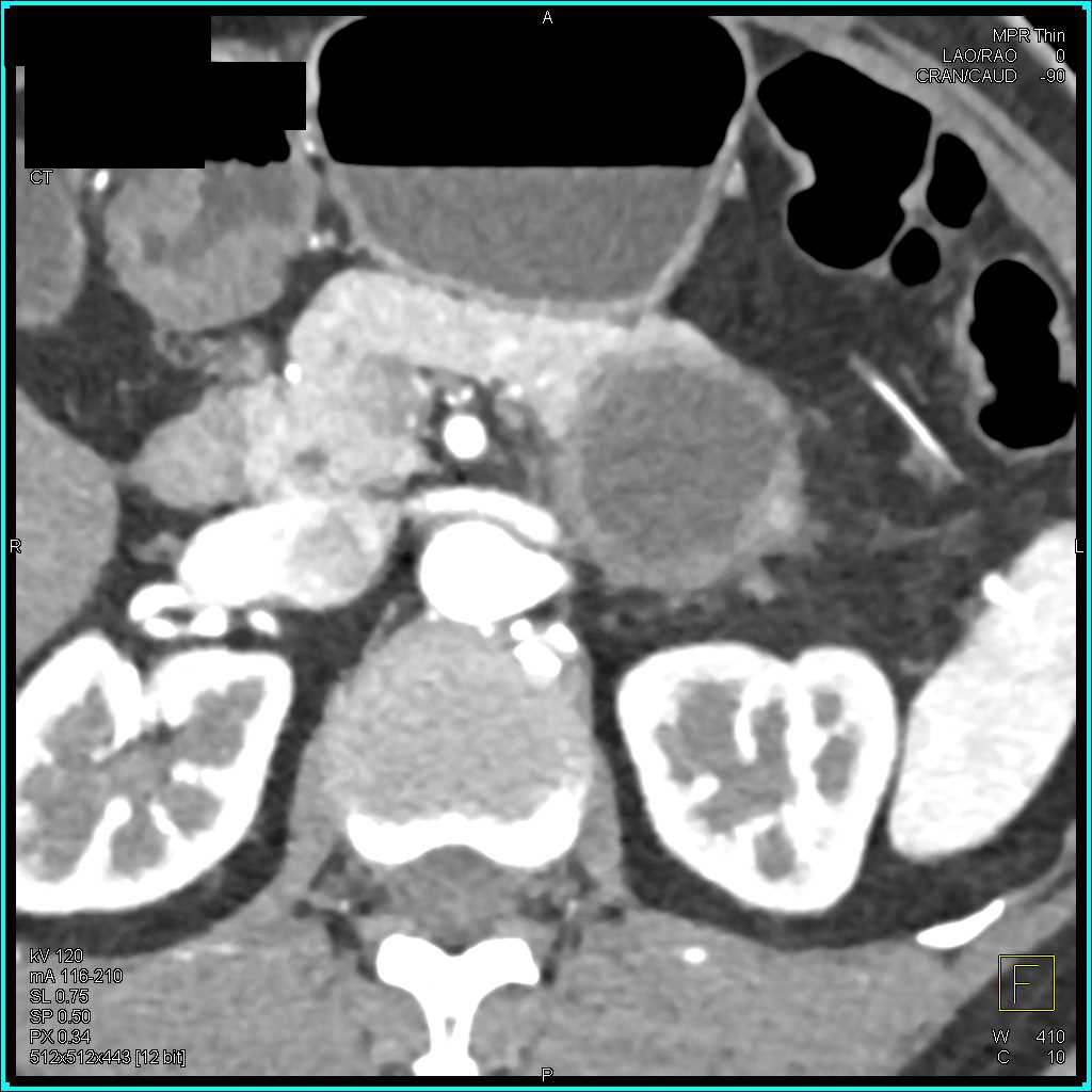 Mucinous Cystic Neoplasm (MCN) of the Pancreas - CTisus CT Scan