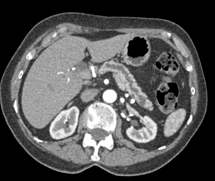 Pancreatic Cancer with Double Duct Sign - CTisus CT Scan