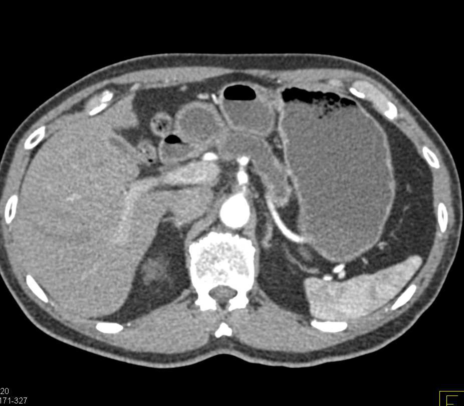Pancreatic Cancer with Obstructed Pancreatic Duct - CTisus CT Scan