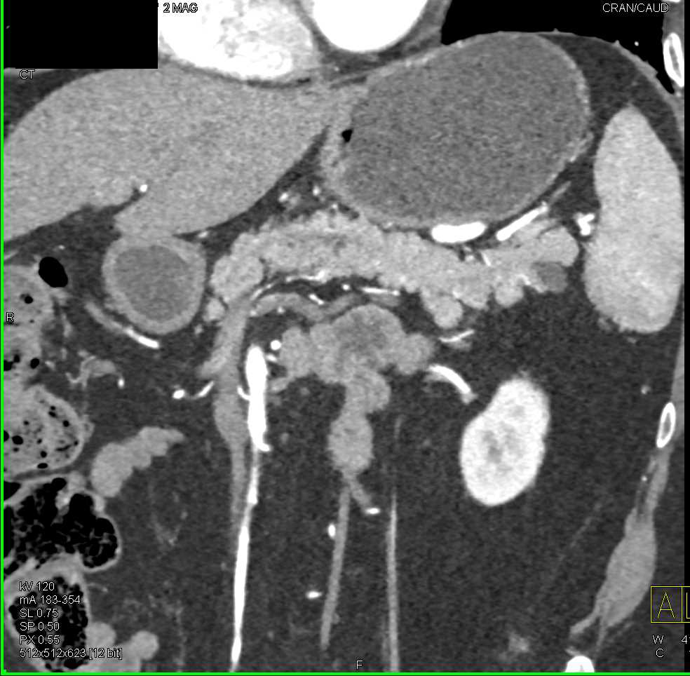Intraductal Papillary Mucinous Neoplasm (IPMN) Tail of the Pancreas - CTisus CT Scan