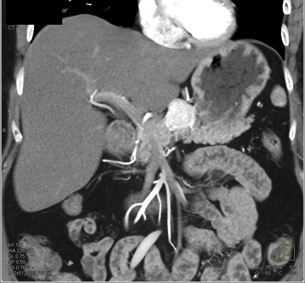 Carcinoma Tail of the Pancreas Involves the Spleen - CTisus CT Scan
