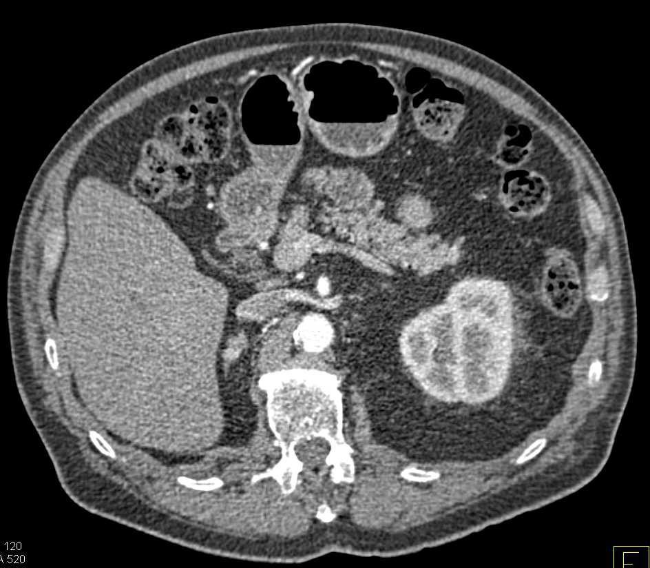 Ampullary Carcinoma Obstructs the Common Bile Duct - CTisus CT Scan