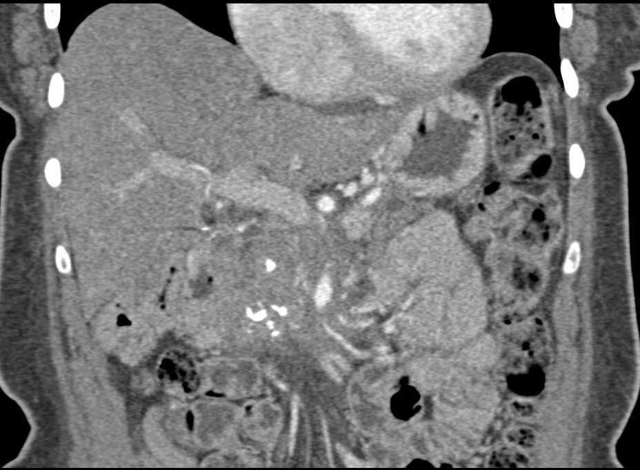 Pancreatic Cancer Arises in a Patient with Chronic Pancreatitis - CTisus CT Scan