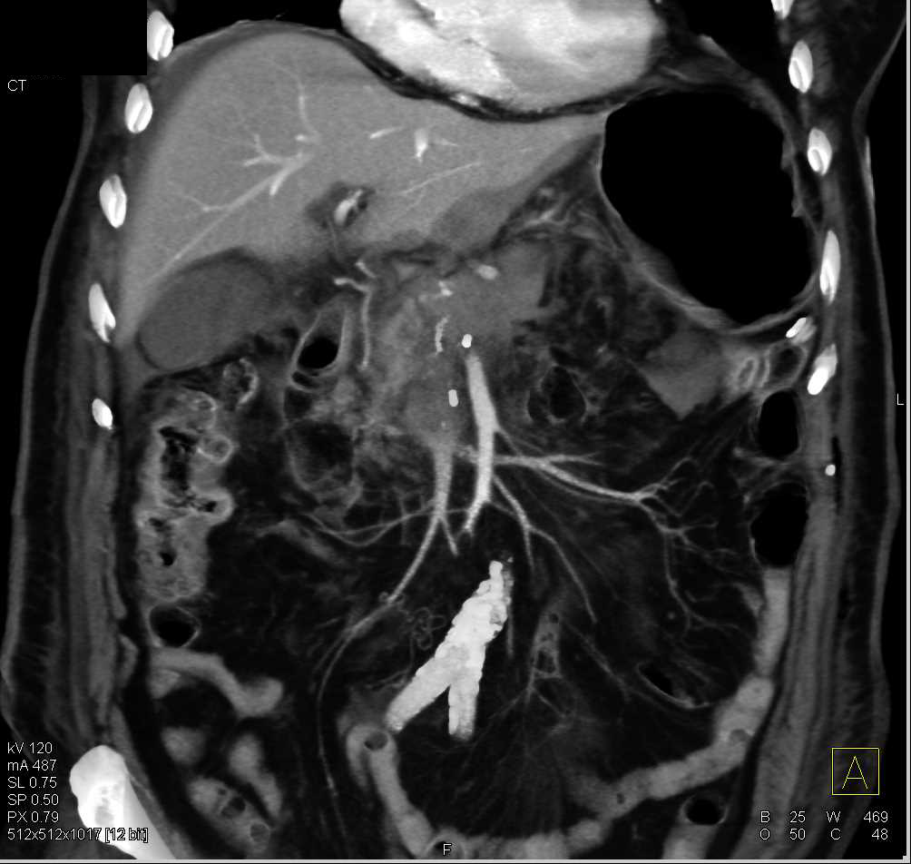 Recurrent Pancreatic Carcinoma - CTisus CT Scan