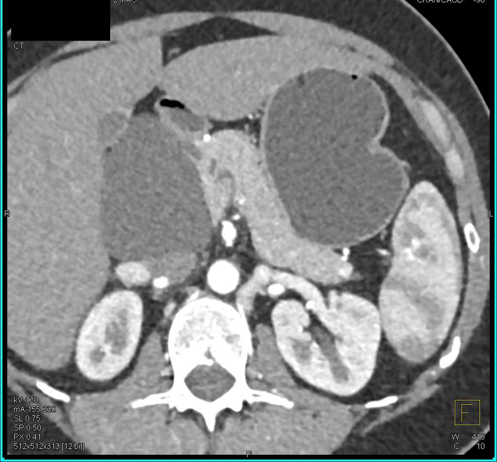 Lymphoepithelial Cyst of the Pancreas - CTisus CT Scan