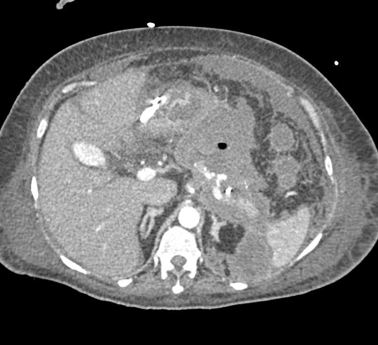 Infiltrating Pancreatic Cancer with Inflammation  and Colitis Right Colon - CTisus CT Scan