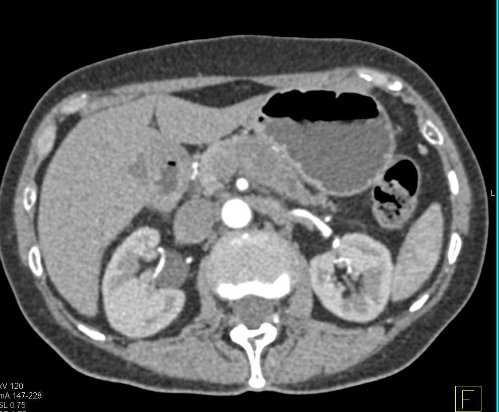 Carcinoma of the Body of the Pancreas - CTisus CT Scan