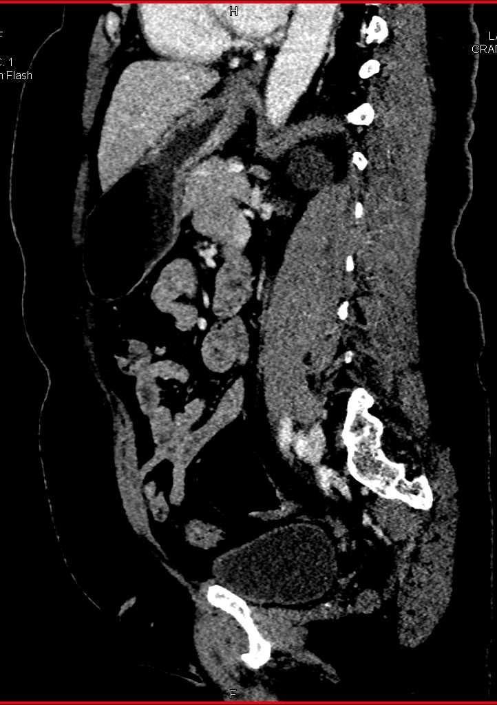 Normal Pancreas - CTisus CT Scan