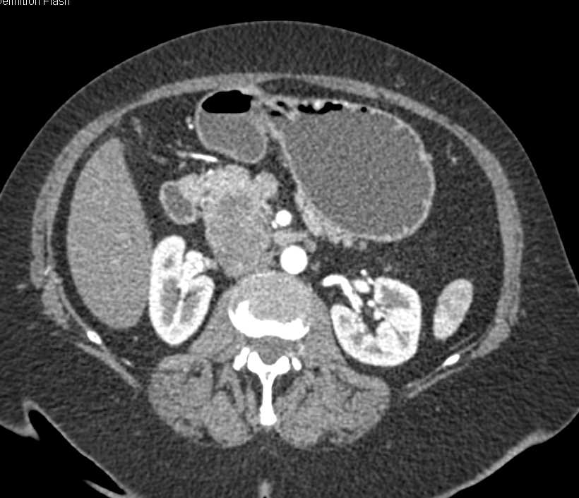 Necrotic Nodes in Portocaval Space Simulating a Pancreatic Mass - CTisus CT Scan