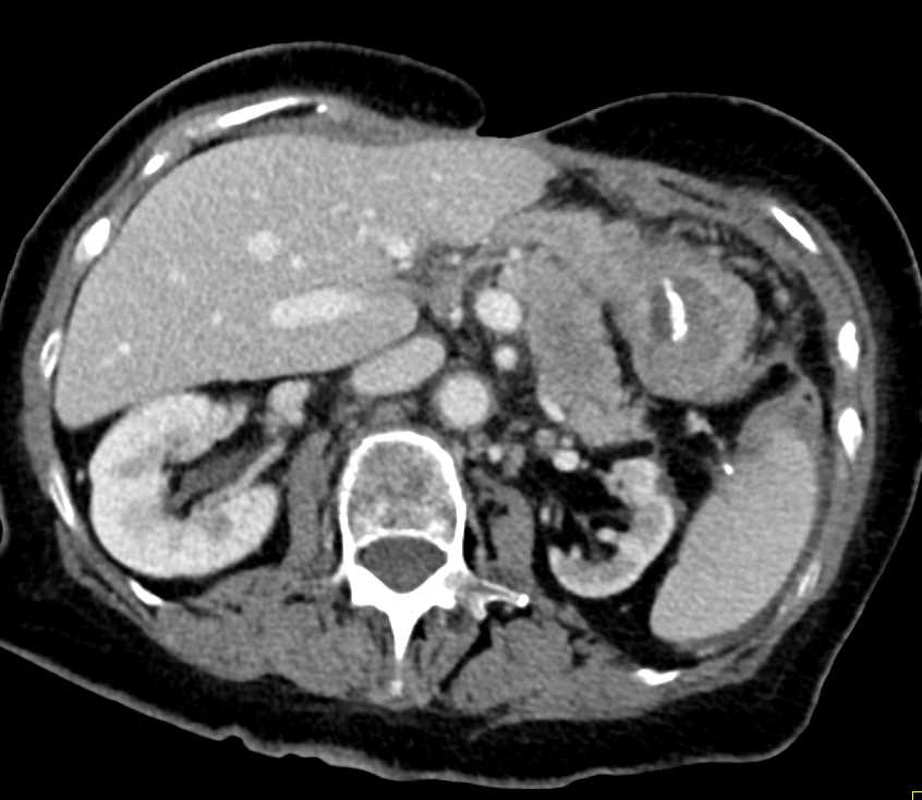 Carcinoma Tail of the Pancreas With Carcinomatosis - CTisus CT Scan
