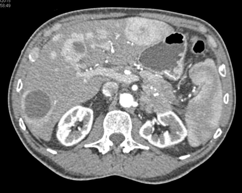 Neuroendocrine Tumor of the Tail of the Pancreas with Liver Metastases - CTisus CT Scan