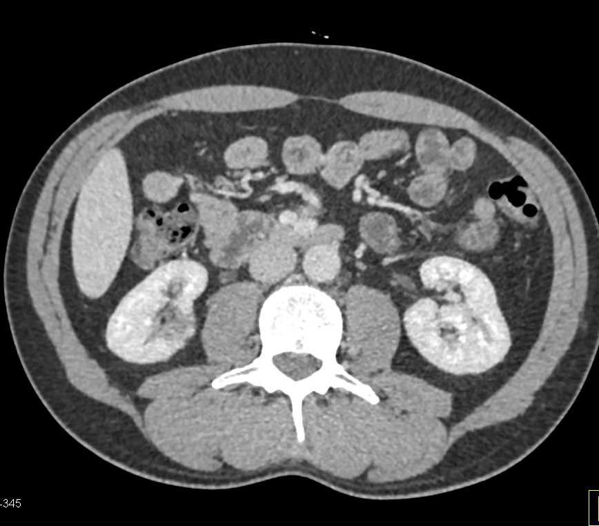 Subtle Carcinoma Arising off the Uncinate Process - CTisus CT Scan