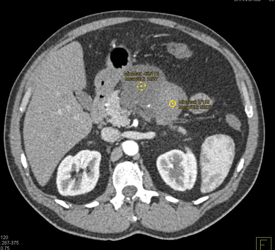Lymphoepithelial Cyst Pancreas - CTisus CT Scan