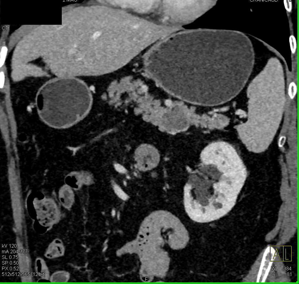 Adenocarcinoma Tail of the Pancreas - CTisus CT Scan