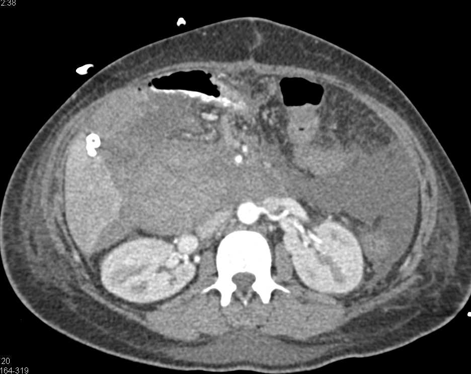 Hemoperitoneum S/P Whipple Procedure - CTisus CT Scan