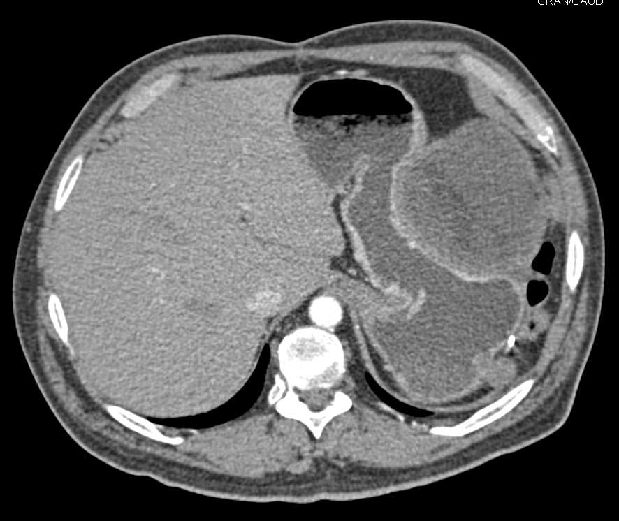 Omental Infarct S/P Distal Pancreatectomy and Splenectomy - CTisus CT Scan