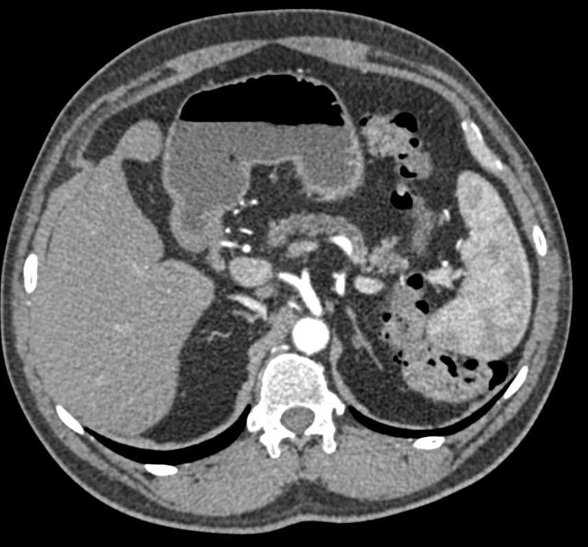 1cm Neuroendocrine Tumor in the Head of the Pancreas - CTisus CT Scan