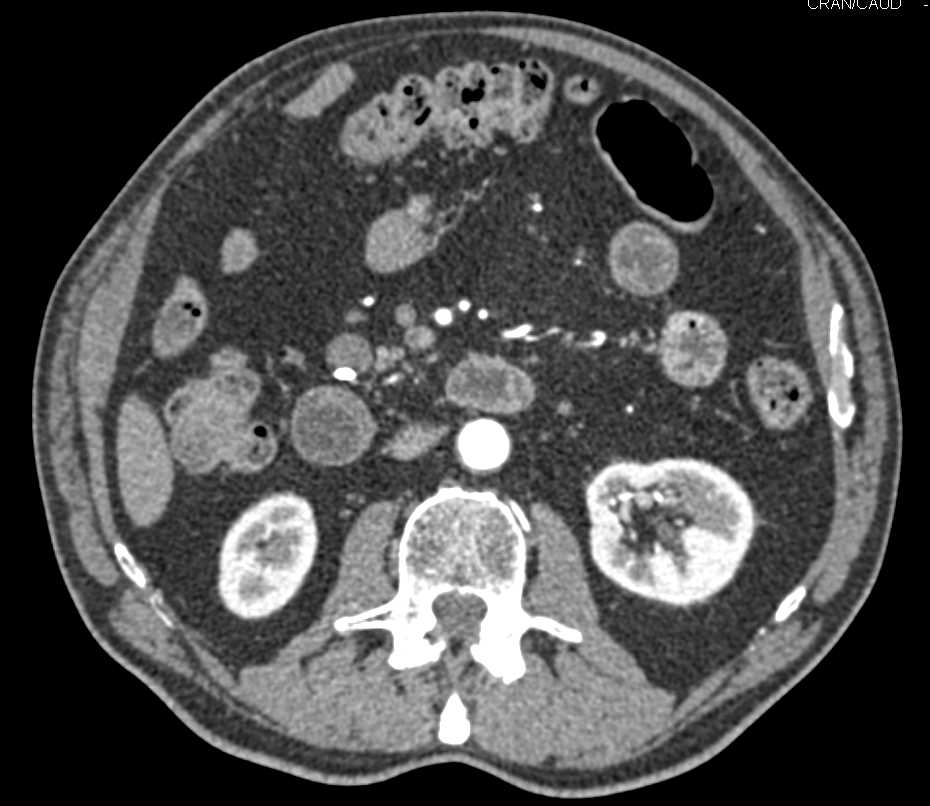 Intraductal Papillary Mucinous Neoplasm (IPMN) Uncinate Process - CTisus CT Scan