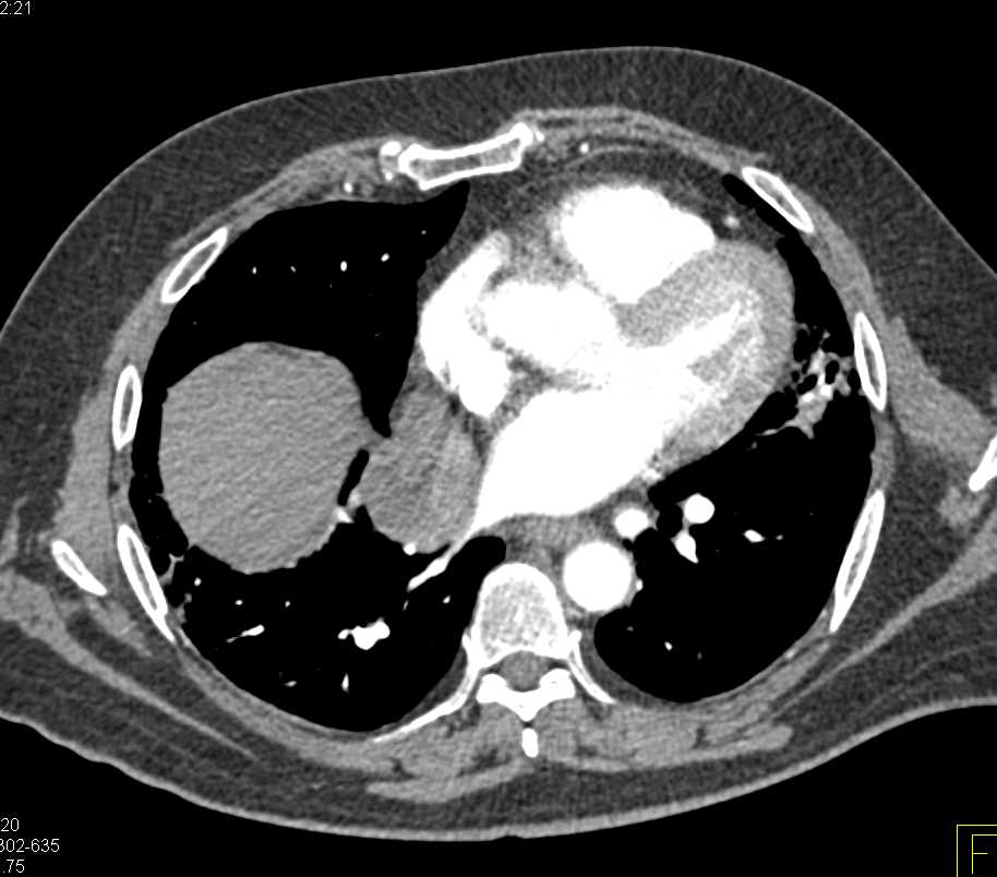 Neuroendocrine Tumor Near Pancreatic Bed - CTisus CT Scan