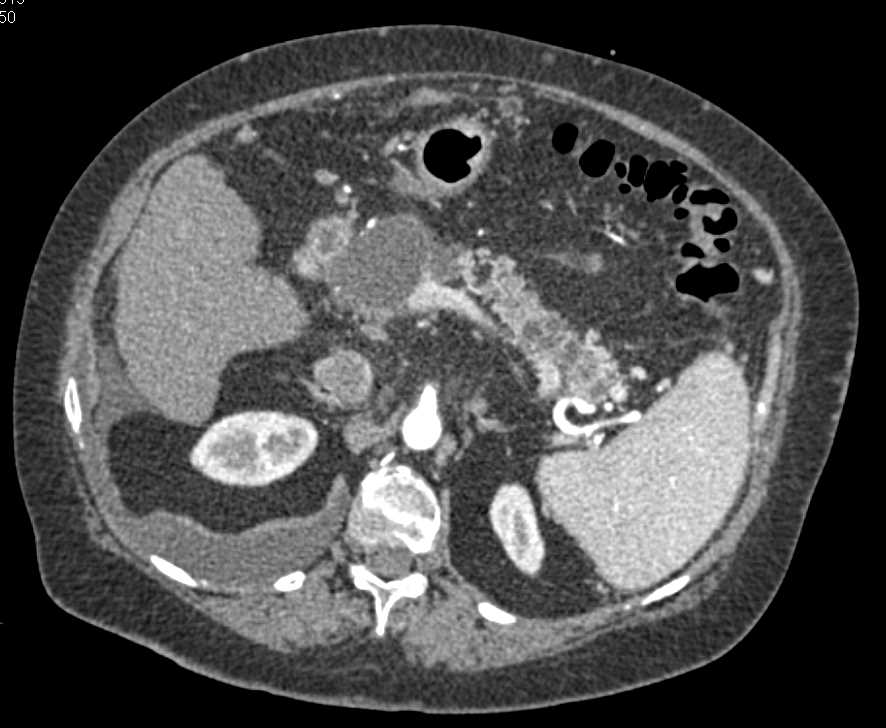 Multiple Intraductal Papillary Mucinous Neoplasms (IPMNs) of the Pancreas - CTisus CT Scan