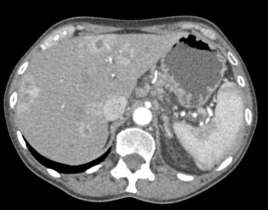 Pancreatic Cancer with Liver Metastases - CTisus CT Scan