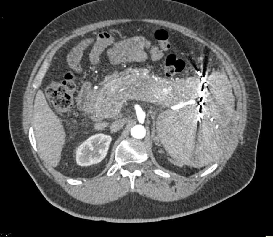 Neuroendocrine Tumor Tail of the Pancreas Involves the Spleen - CTisus CT Scan