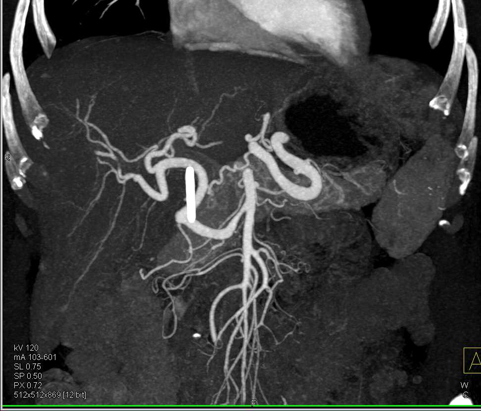 Omental Infarct at Site of Distal Pancreatectomy and Splenectomy - CTisus CT Scan