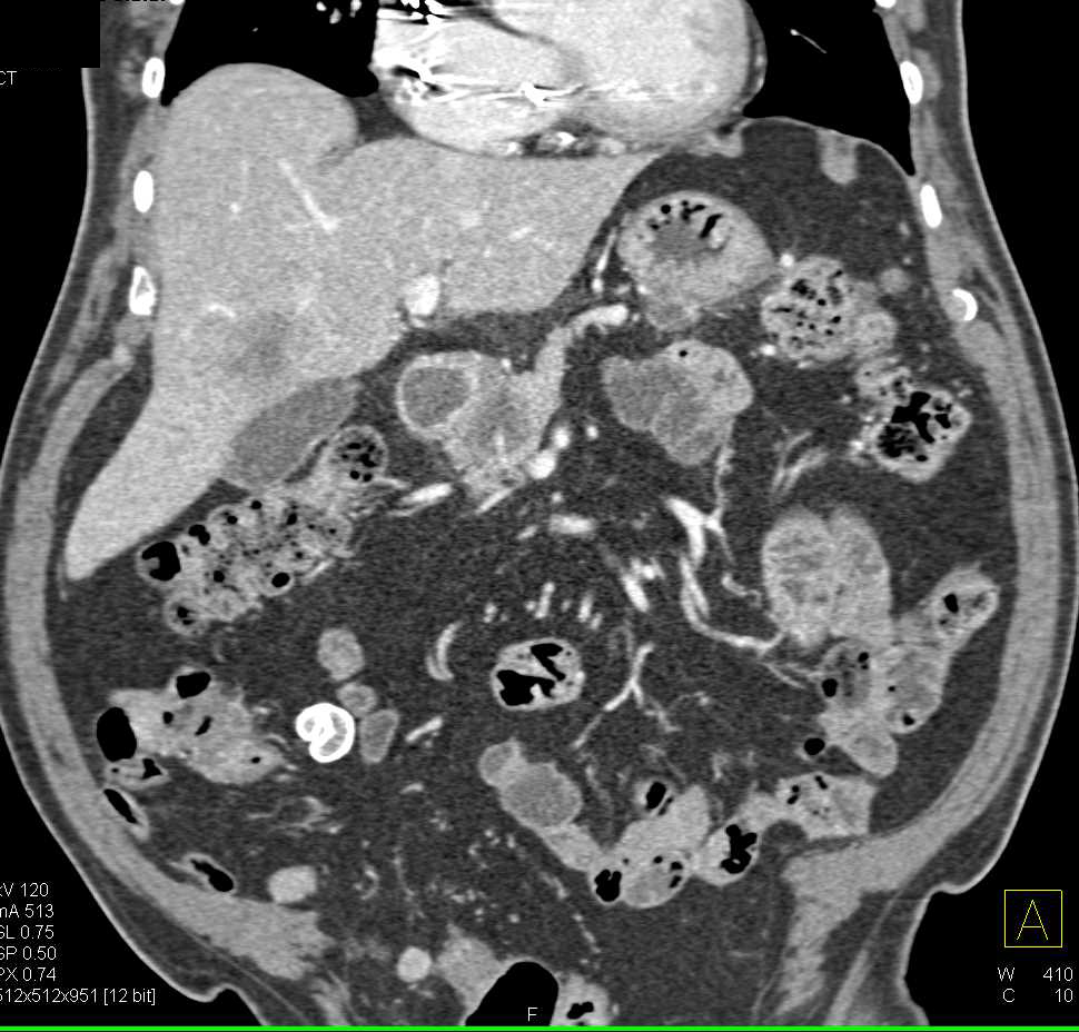 Pancreatic Cancer Invades the Spleen - CTisus CT Scan
