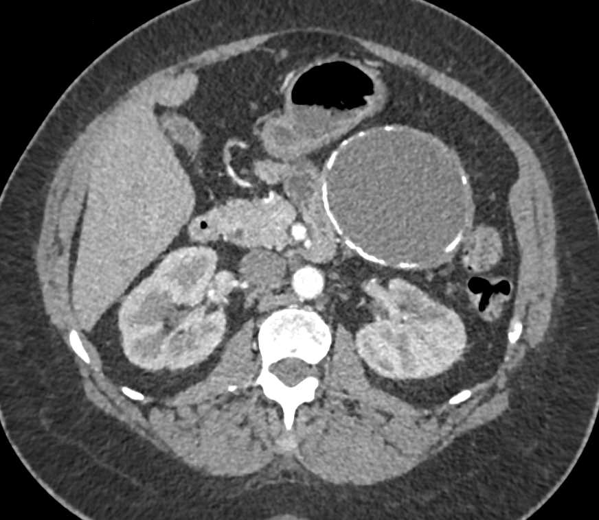 Calcified Mesenteric Cyst Involves the Pancreas - CTisus CT Scan