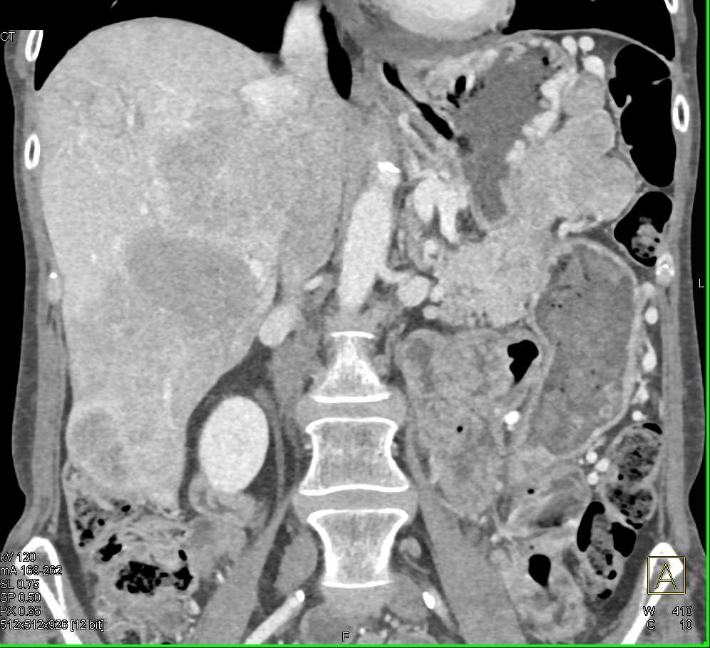 Metastatic Neuroendocrine Tumor of the Tail of the Pancreas with Liver Metastases - CTisus CT Scan