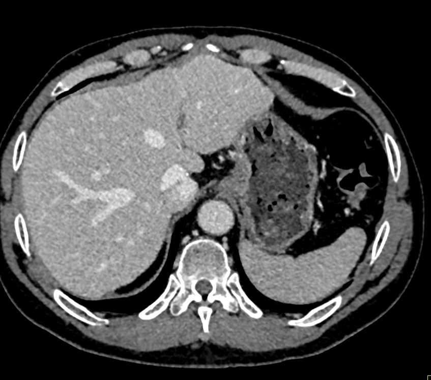 Pancreatic Cancer with Liver Metastases - CTisus CT Scan